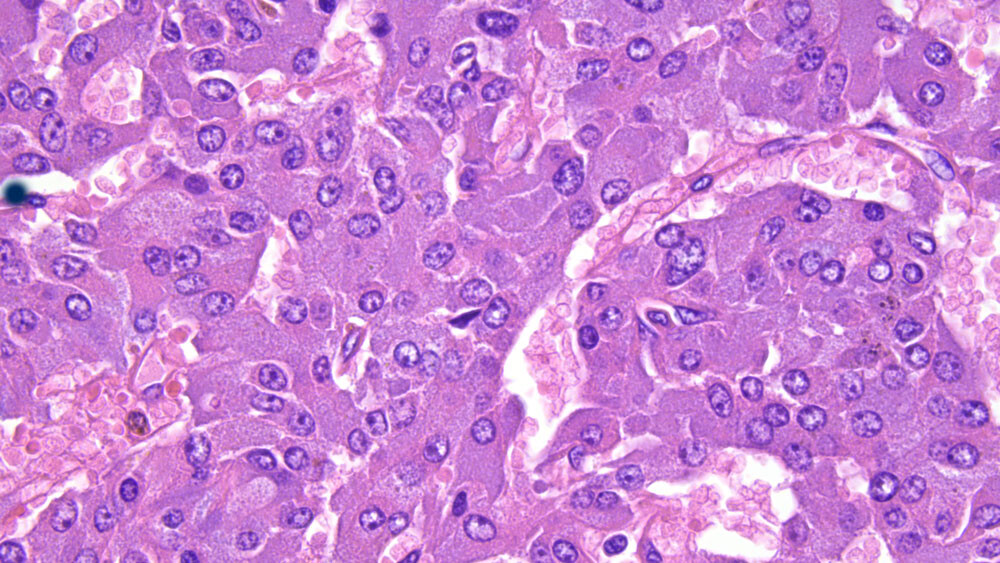 Adrenal-Tumour-40x