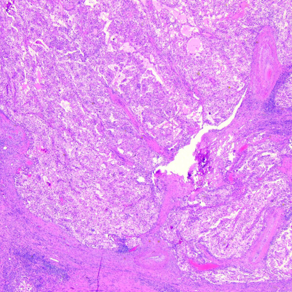 Kidney tumour low power